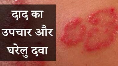 दाद का उपचार और घरेलु दवा