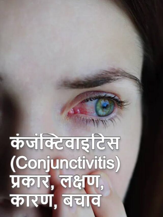 कंजंक्टिवाइटिस (Conjunctivitis) : प्रकार, लक्षण, कारण, बचाव